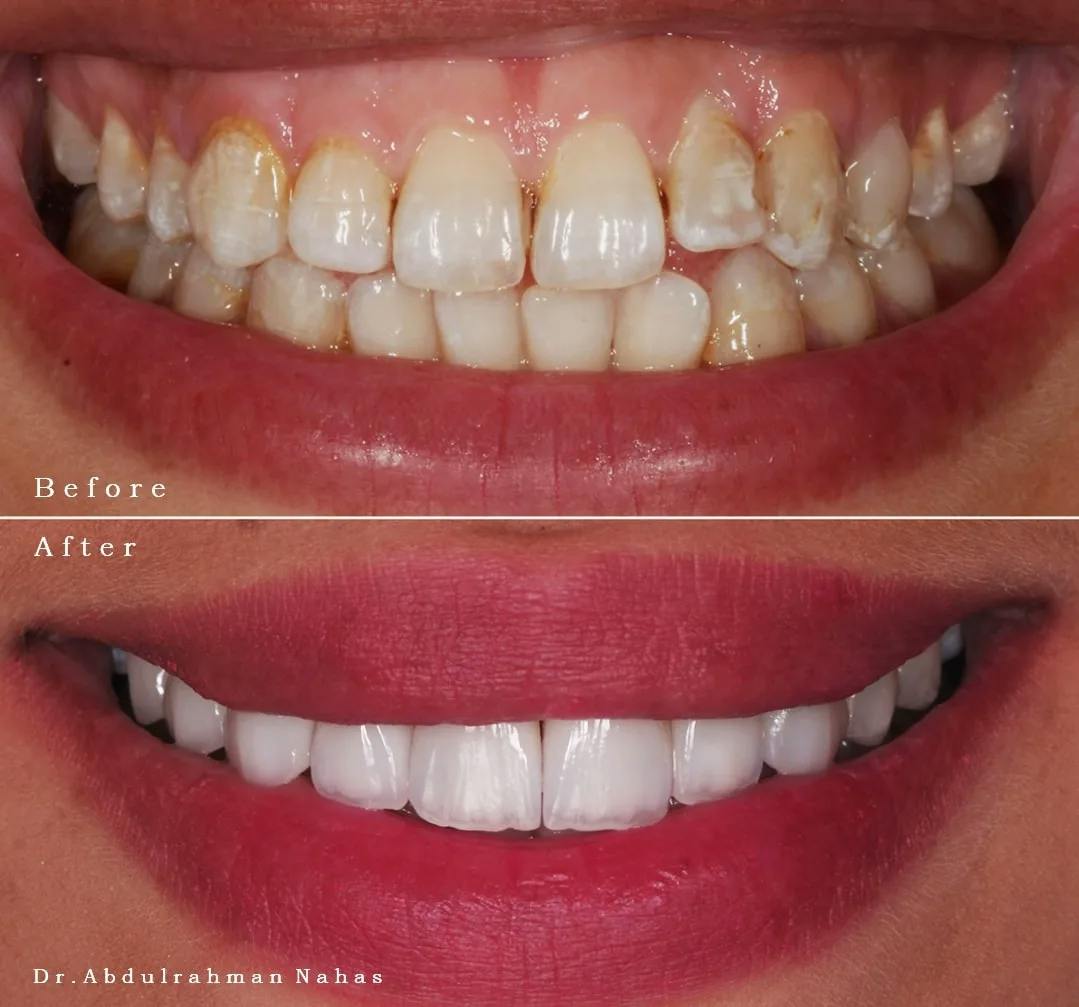 Teeth Whitening
